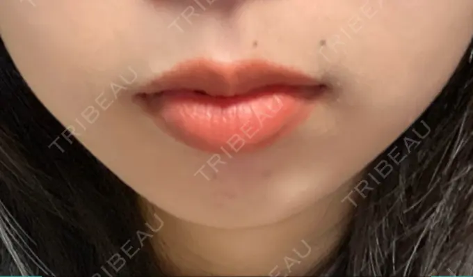 ボトックス（口角） Olino美容外科・美容皮膚科 DAY 3 メイン用