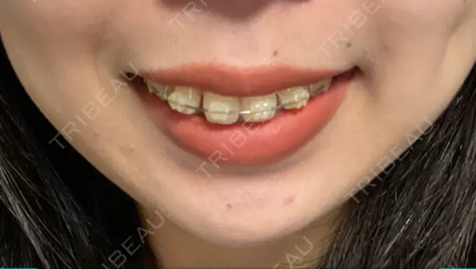 ボトックス（口角） Olino美容外科・美容皮膚科 DAY 3 メイン用