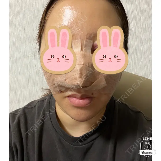 鼻尖形成（切開） / ワシ鼻修正・ハンプ切除 みずほクリニック DAY 2 メイン用