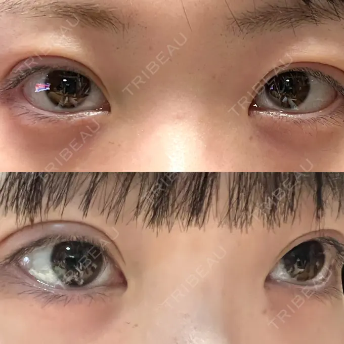 二重埋没 / 眼瞼下垂（非切開） WOM CLINIC GINZA （ワム クリニック ギンザ） DAY 0 メイン用