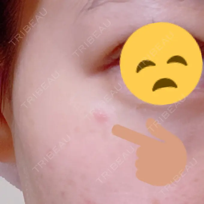 ピコスポット LOUIS CLINIC 二子玉川院【ルイクリニック】 DAY 0 メイン用