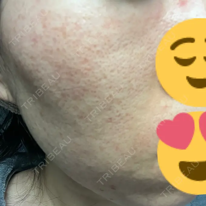 イオン導入 / ニードルRF（ポテンツァなど） オラクル美容皮膚科 名古屋院 DAY 8 メイン用