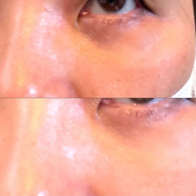 ヒアルロン酸注入（涙袋） / ボトックス（眉間） TCB東京中央美容外科 心斎橋院 DAY 385 メイン用