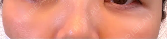 ヒアルロン酸注入（涙袋） / ボトックス（眉間） TCB東京中央美容外科 心斎橋院 AFTER メイン用