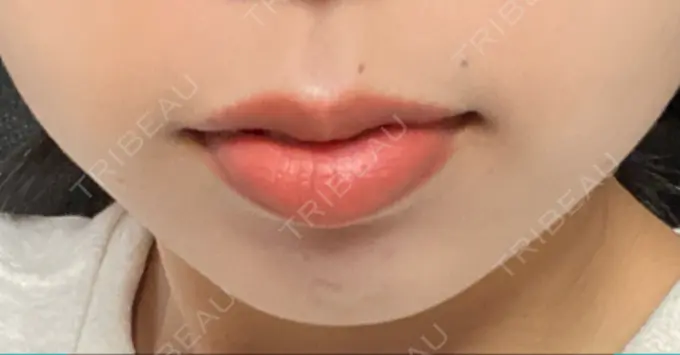 ボトックス（口角） Olino美容外科・美容皮膚科 DAY 4 メイン用