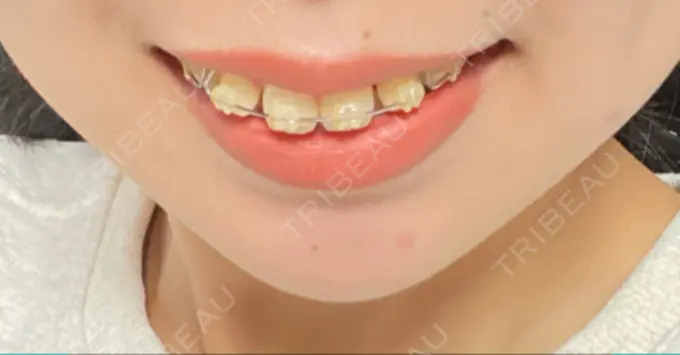 ボトックス（口角） Olino美容外科・美容皮膚科 DAY 4 メイン用