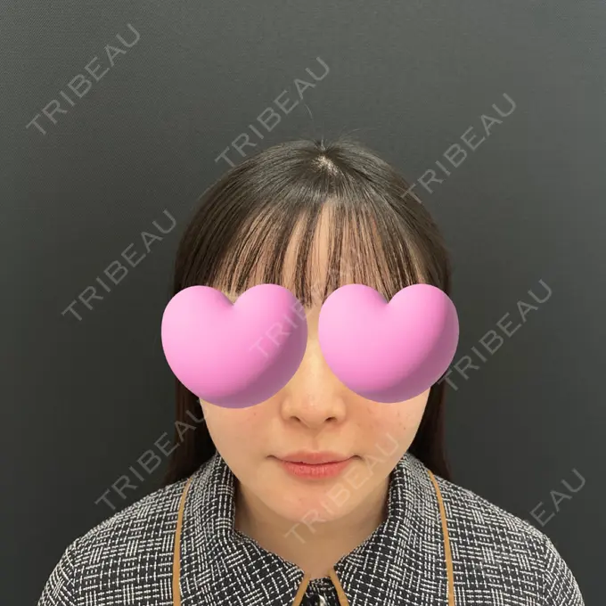 糸リフト / 脂肪吸引（顔） / ジョールファット除去 東京シンデレラ美容外科 池袋院 AFTER メイン用