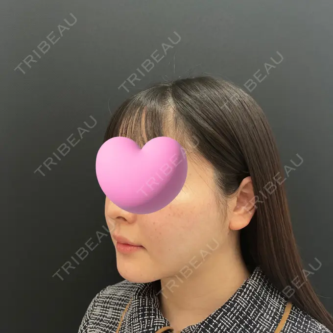 糸リフト / 脂肪吸引（顔） / ジョールファット除去 東京シンデレラ美容外科 池袋院 DAY 30 メイン用