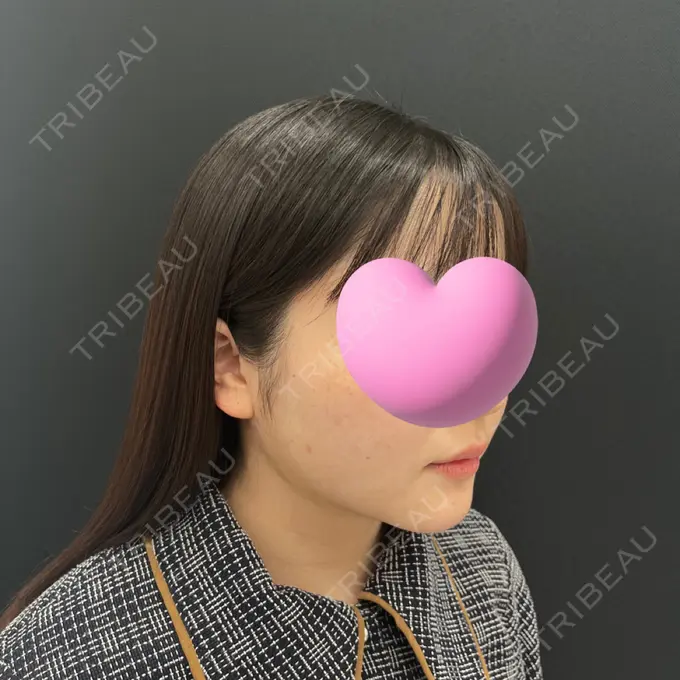 糸リフト / 脂肪吸引（顔） / ジョールファット除去 東京シンデレラ美容外科 池袋院 DAY 30 メイン用