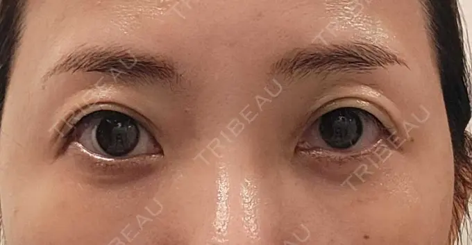 クマ治療 / 下まぶたたるみ取り / その他（目元） セオリークリニック DAY 30 メイン用