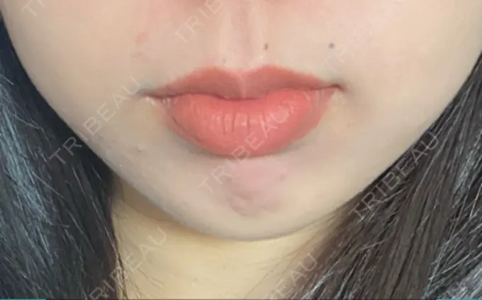 ボトックス（口角） Olino美容外科・美容皮膚科 DAY 5 メイン用