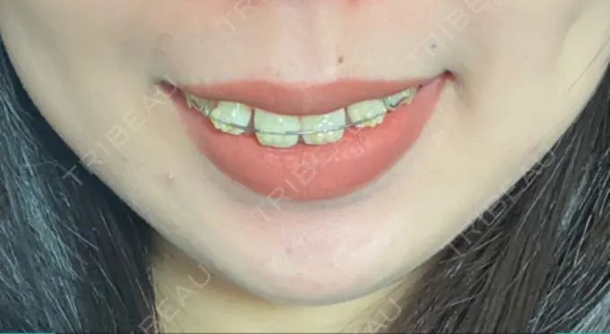 ボトックス（口角） Olino美容外科・美容皮膚科 DAY 5 メイン用