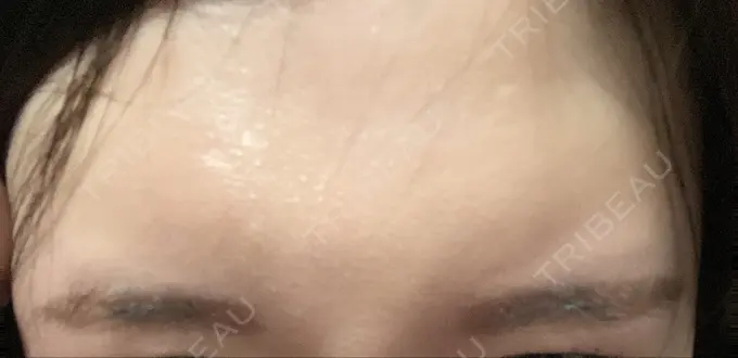 ボトックス（眉間） TCB東京中央美容外科 中野院 DAY 14 メイン用