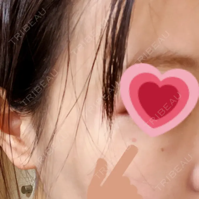 ピコスポット LOUIS CLINIC 二子玉川院【ルイクリニック】 DAY 3 メイン用