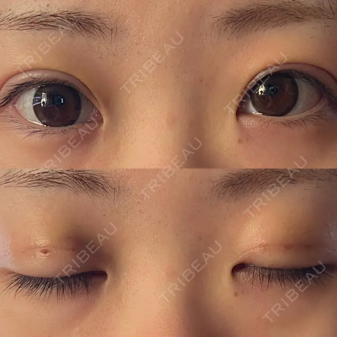 二重埋没 / 眼瞼下垂（非切開） WOM CLINIC GINZA （ワム クリニック ギンザ） DAY 2 メイン用