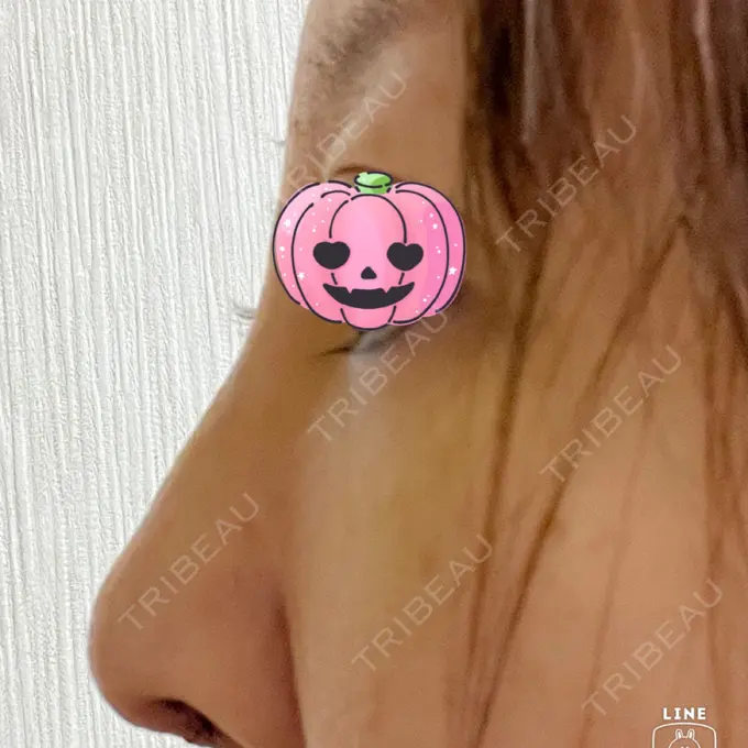 鼻尖形成（切開） / ワシ鼻修正・ハンプ切除 みずほクリニック DAY 5 メイン用