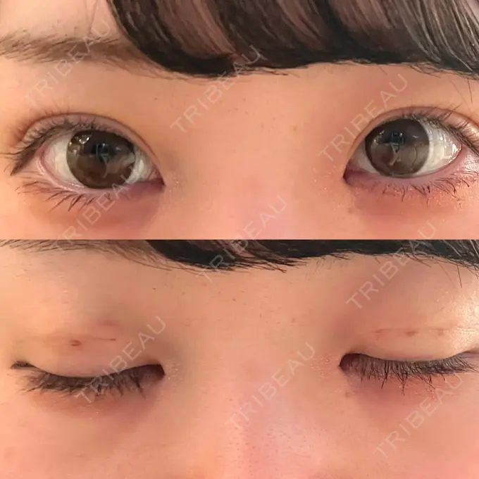 二重埋没 / 眼瞼下垂（非切開） WOM CLINIC GINZA （ワム クリニック ギンザ） DAY 3 メイン用