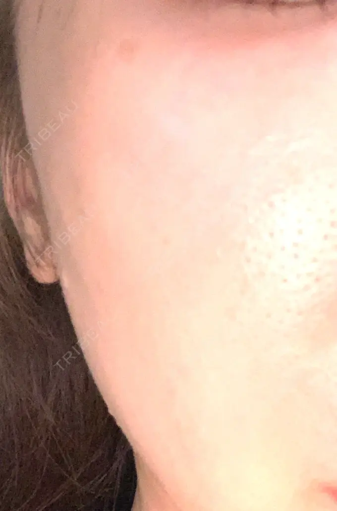 ヒアルロン酸注入（頬） 十仁美容整形 AFTER メイン用