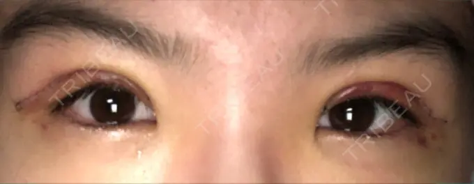 二重切開 / 上まぶたの脂肪取り ブリスクリニック形成外科・美容外科・美容皮膚科 福岡 DAY 3 メイン用