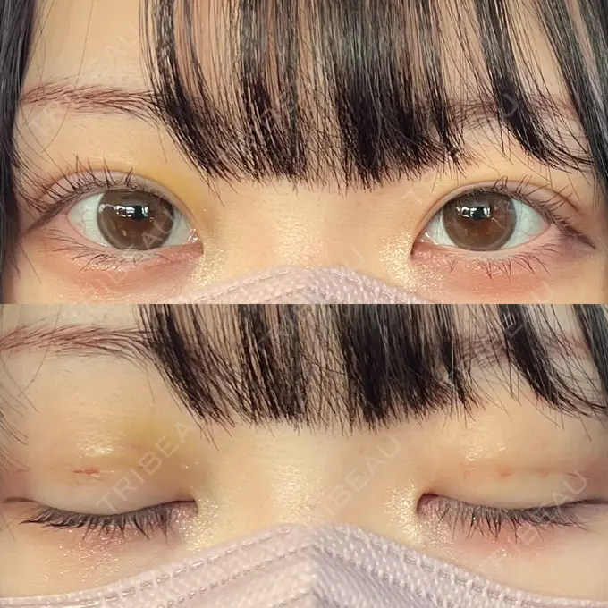 二重埋没 / 眼瞼下垂（非切開） WOM CLINIC GINZA （ワム クリニック ギンザ） DAY 4 メイン用