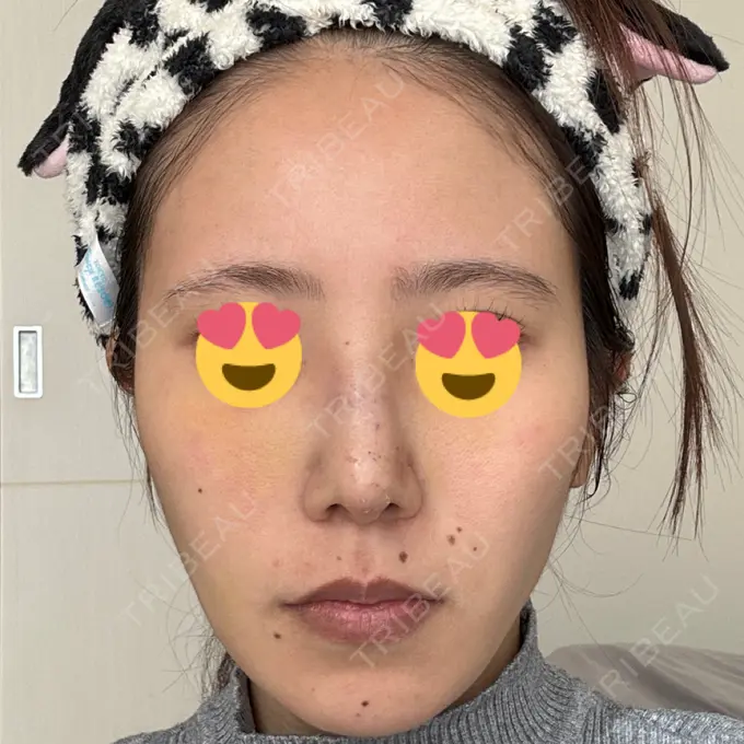 軟骨移植 / 骨切幅寄せ / ワシ鼻修正・ハンプ切除 / 鼻尖形成（非切開） 銀座マイアミ美容外科 DAY 7 メイン用