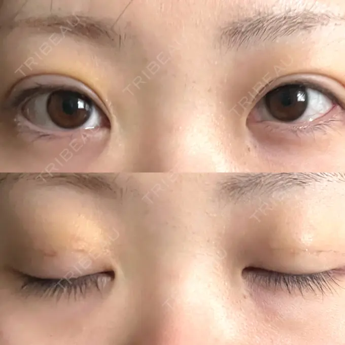 二重埋没 / 眼瞼下垂（非切開） WOM CLINIC GINZA （ワム クリニック ギンザ） DAY 5 メイン用