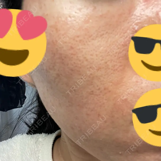 イオン導入 / ニードルRF（ポテンツァなど） オラクル美容皮膚科 名古屋院 DAY 9 メイン用