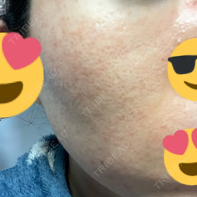 イオン導入 / ニードルRF（ポテンツァなど） オラクル美容皮膚科 名古屋院 AFTER メイン用