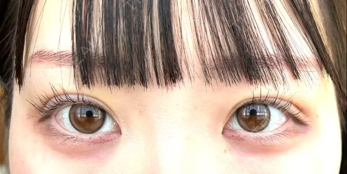 二重埋没 / 眼瞼下垂（非切開） WOM CLINIC GINZA （ワム クリニック ギンザ） DAY 6 メイン用