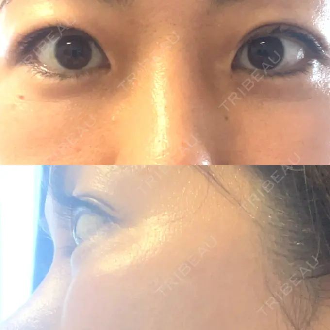 下まぶたたるみ取り セオリークリニック DAY 31 メイン用