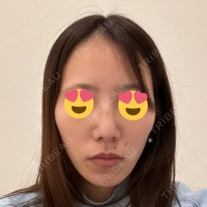 軟骨移植 / 骨切幅寄せ / ワシ鼻修正・ハンプ切除 / 鼻尖形成（非切開） 銀座マイアミ美容外科 DAY 10 メイン用