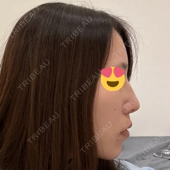 軟骨移植 / 骨切幅寄せ / ワシ鼻修正・ハンプ切除 / 鼻尖形成（非切開） 銀座マイアミ美容外科 DAY 10 メイン用