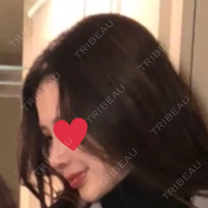 鼻中隔延長（切開） / 小鼻縮小（切開） / 鼻尖縮小 みずほクリニック AFTER メイン用