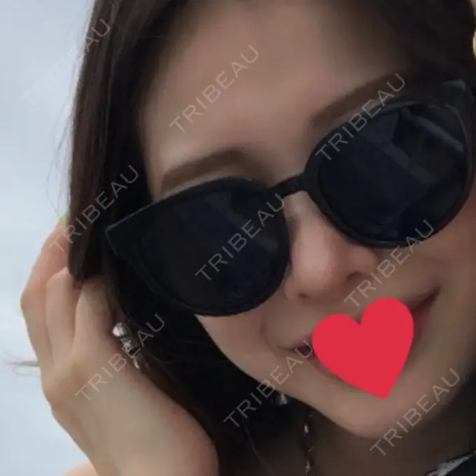 鼻中隔延長（切開） / 小鼻縮小（切開） / 鼻尖縮小 みずほクリニック DAY 365 メイン用