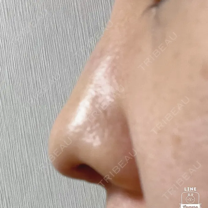 鼻尖形成（切開） / ワシ鼻修正・ハンプ切除 みずほクリニック DAY 11 メイン用