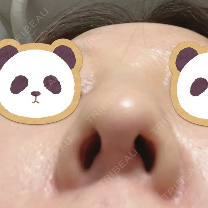 鼻尖形成（切開） / ワシ鼻修正・ハンプ切除 みずほクリニック DAY 11 メイン用