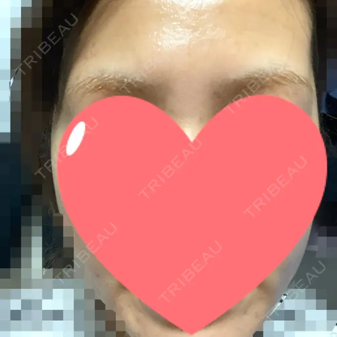 ピーリング（ニキビ・毛穴） / ピコレーザートーニング（美白・肝斑） / ピーリング（ハリ・ツヤ） / ニキビ治療 ルラ美容クリニック 高田馬場院 DAY 6 メイン用