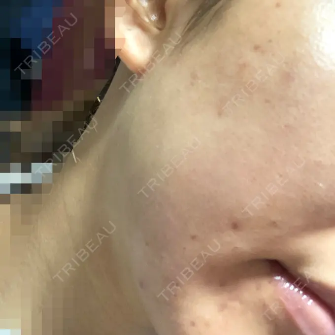 ピーリング（ニキビ・毛穴） / ピコレーザートーニング（美白・肝斑） / ピーリング（ハリ・ツヤ） / ニキビ治療 ルラ美容クリニック 高田馬場院 DAY 6 メイン用