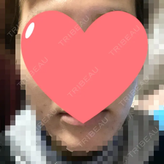 ピーリング（ニキビ・毛穴） / ピコレーザートーニング（美白・肝斑） / ピーリング（ハリ・ツヤ） / ニキビ治療 ルラ美容クリニック 高田馬場院 DAY 7 メイン用