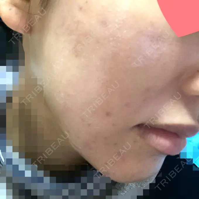 ピーリング（ニキビ・毛穴） / ピコレーザートーニング（美白・肝斑） / ピーリング（ハリ・ツヤ） / ニキビ治療 ルラ美容クリニック 高田馬場院 DAY 7 メイン用