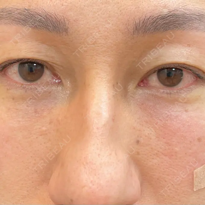 クマ治療 / シワ取りボトックス セオリークリニック DAY 0 メイン用