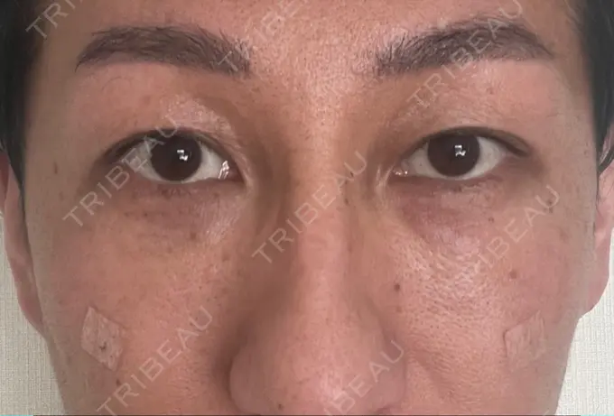 クマ治療 / シワ取りボトックス セオリークリニック DAY 1 メイン用