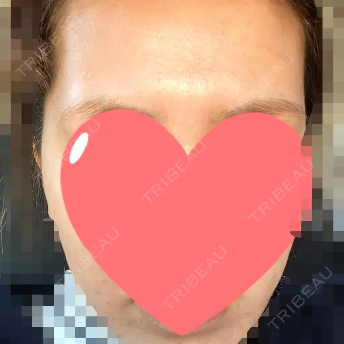 ピーリング（ニキビ・毛穴） / ピコレーザートーニング（美白・肝斑） / ピーリング（ハリ・ツヤ） / ニキビ治療 ルラ美容クリニック 高田馬場院 DAY 8 メイン用