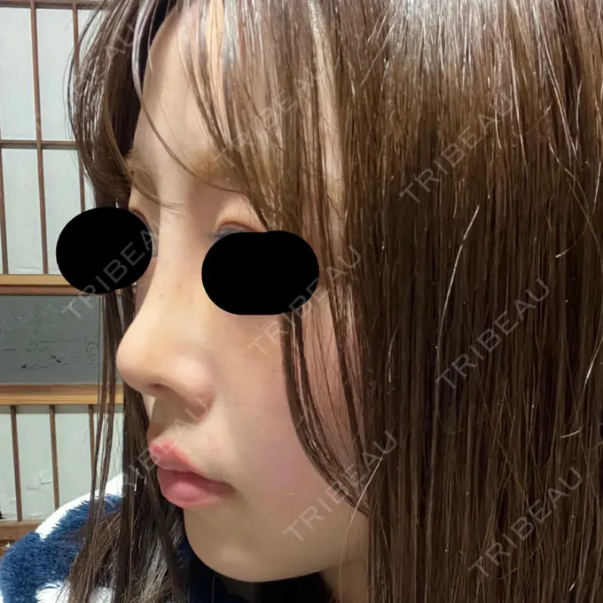 隆鼻術 / 鼻尖形成（切開） / 軟骨移植 / 鼻柱下降・鼻唇角形成（猫手術） グローバルビューティークリニック 大阪院 DAY 9 メイン用