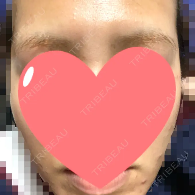 ピーリング（ニキビ・毛穴） / ピコレーザートーニング（美白・肝斑） / ピーリング（ハリ・ツヤ） / ニキビ治療 ルラ美容クリニック 高田馬場院 DAY 9 メイン用