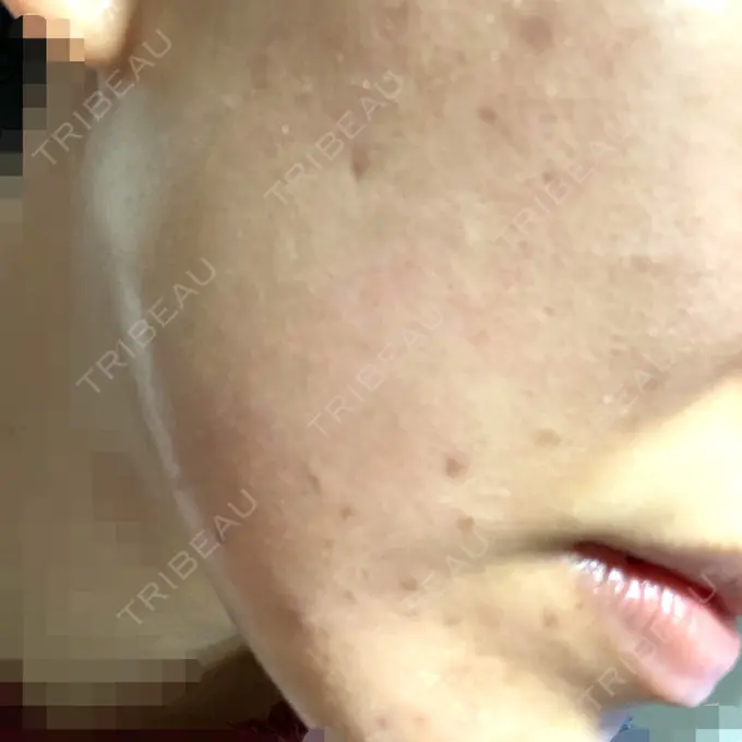 ピーリング（ニキビ・毛穴） / ピコレーザートーニング（美白・肝斑） / ピーリング（ハリ・ツヤ） / ニキビ治療 ルラ美容クリニック 高田馬場院 DAY 9 メイン用