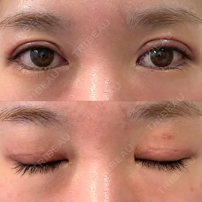 二重切開 / 上まぶたたるみ取り みずほクリニック DAY 9 メイン用