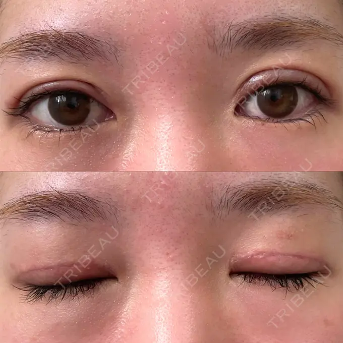 二重切開 / 上まぶたたるみ取り みずほクリニック DAY 10 メイン用