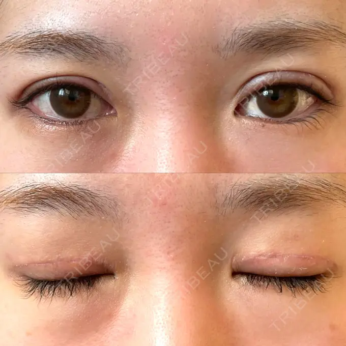 二重切開 / 上まぶたたるみ取り みずほクリニック DAY 11 メイン用