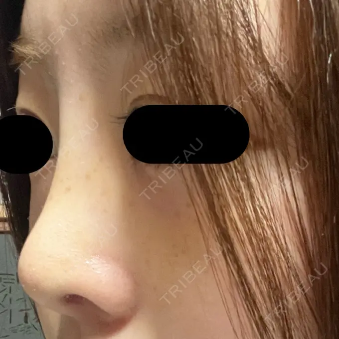 隆鼻術 / 鼻尖形成（切開） / 軟骨移植 / 鼻柱下降・鼻唇角形成（猫手術） グローバルビューティークリニック 大阪院 DAY 10 メイン用